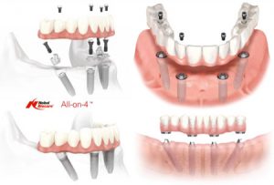 lavoro-all-on-four-450x304